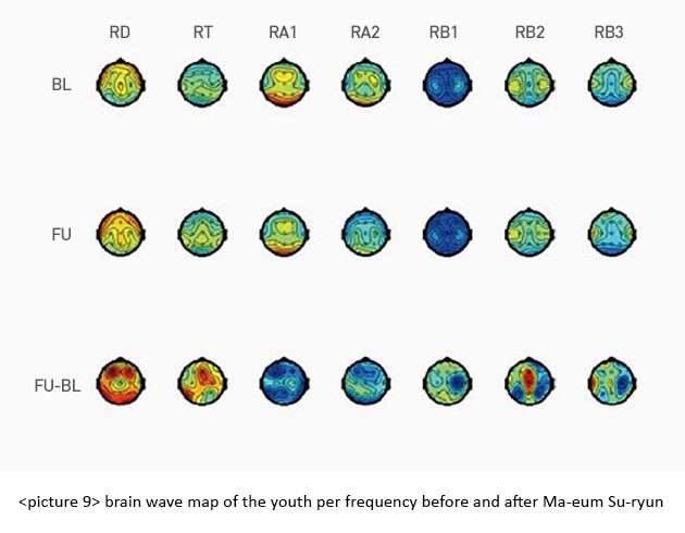 Altered Upper Alpha Brain Wave of Adolescents and Teachers